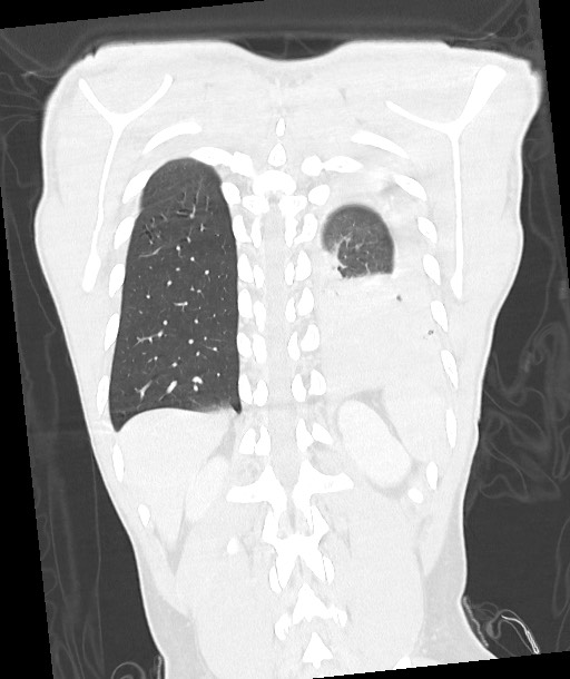 Arrow injury to the chest (Radiopaedia 85367-100975 Coronal lung window 105).jpg