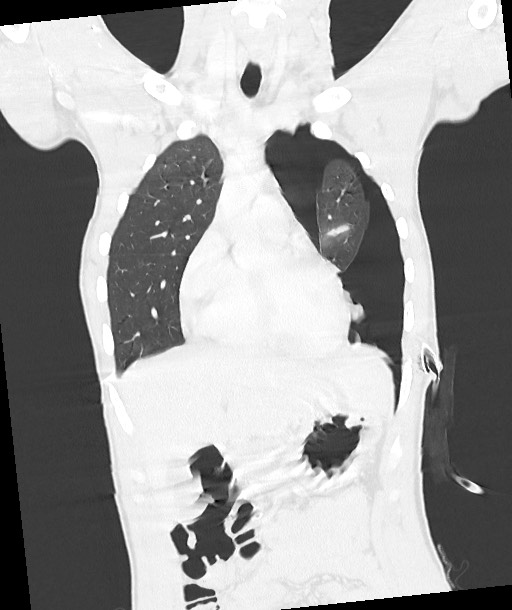 Arrow injury to the chest (Radiopaedia 85367-100975 Coronal lung window 59).jpg