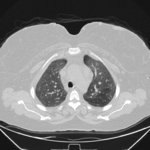 Aspergilloma (Radiopaedia 39611-41932 Axial lung window 32).jpg