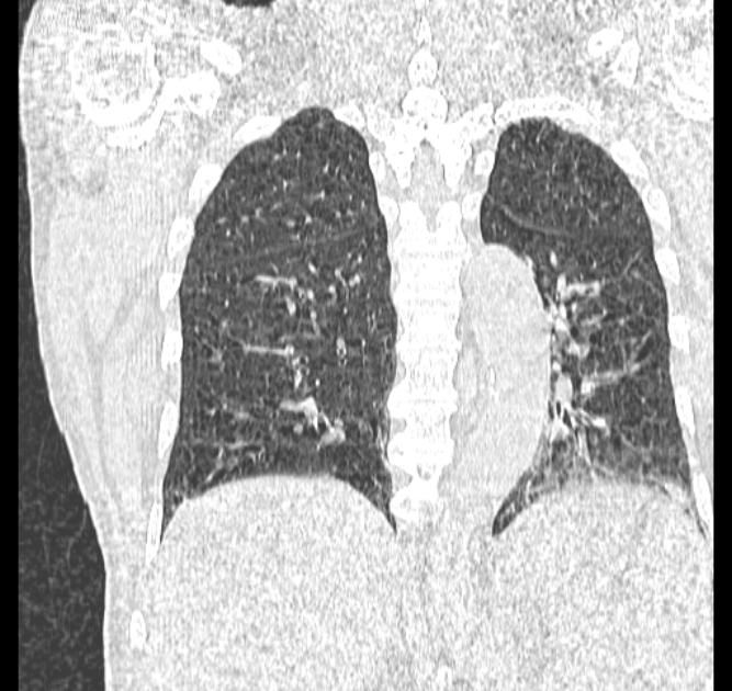 Aspergilloma (Radiopaedia 44592-48327 Coronal lung window 91).jpg