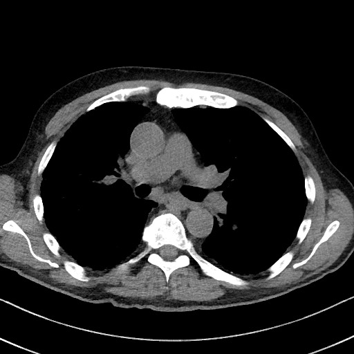 Aspergilloma on background pulmonary fibrosis (Radiopaedia 60942-68757 Axial non-contrast 27).jpg
