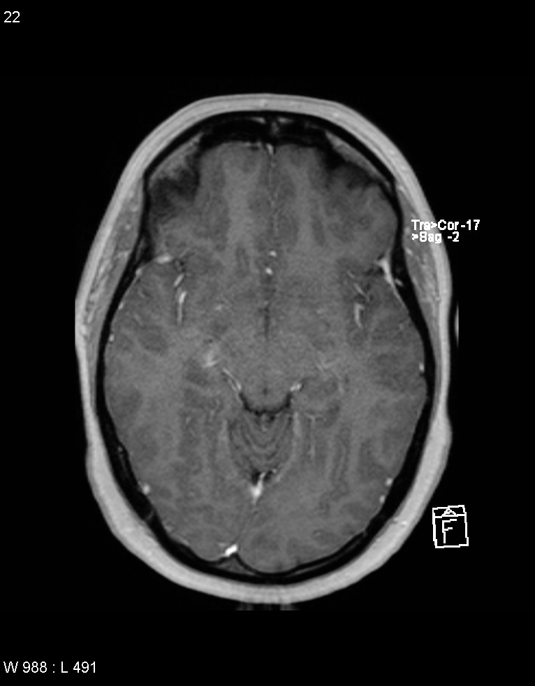 Astroblastoma (Radiopaedia 39792-42217 Axial T1 C+ 21).jpg