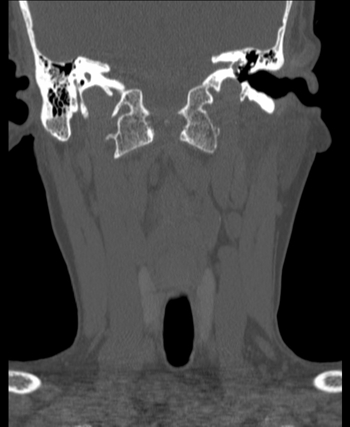 Atlanto-occipital assimilation with basilar invagination (Radiopaedia 70122-80188 Coronal bone window 55).jpg