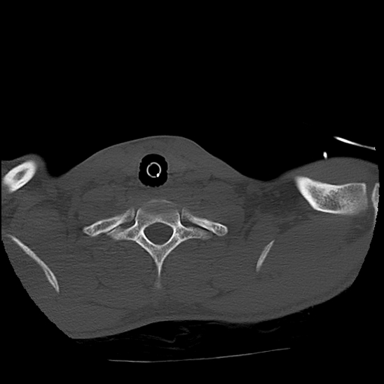 File:Atlanto-occipital dissociation (Traynelis type 1), C2 teardrop fracture, C6-7 facet joint dislocation (Radiopaedia 87655-104061 Axial bone window 83).jpg
