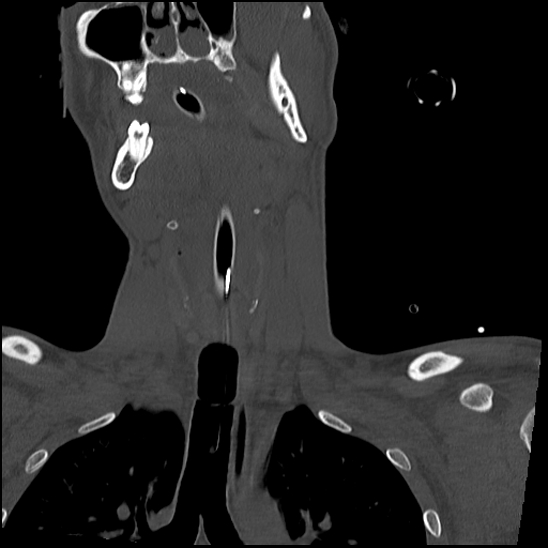 Atlanto-occipital dissociation (Traynelis type 1), C2 teardrop fracture, C6-7 facet joint dislocation (Radiopaedia 87655-104061 Coronal bone window 24).jpg