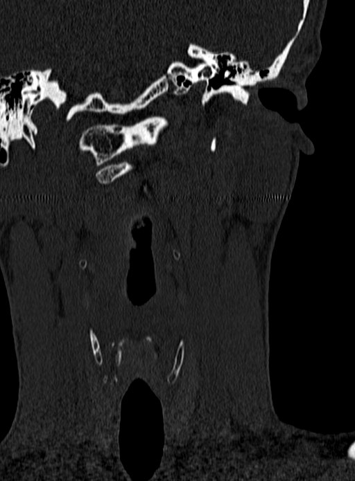 Atlantoaxial subluxation (Radiopaedia 44681-48450 Coronal bone window 3).jpg
