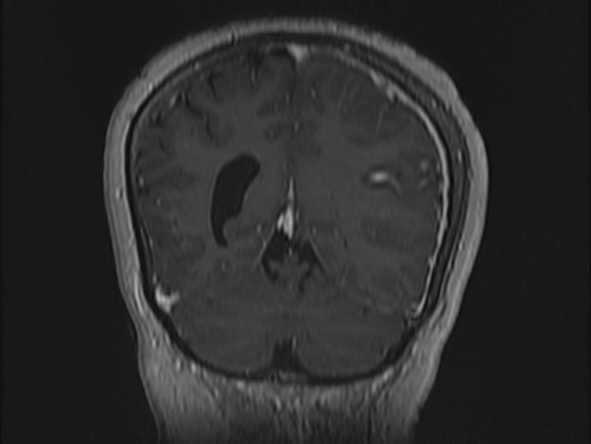 Atypical meningioma (Radiopaedia 62985-71406 Coronal T1 C+ 99).jpg