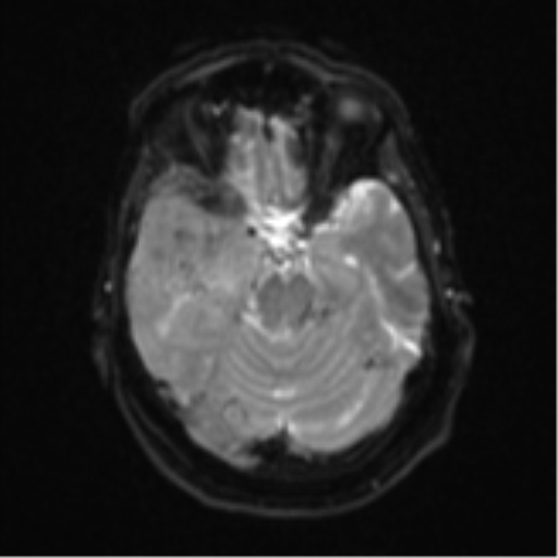 Atypical meningioma (WHO Grade II) (Radiopaedia 54742-60979 Axial DWI 10).png