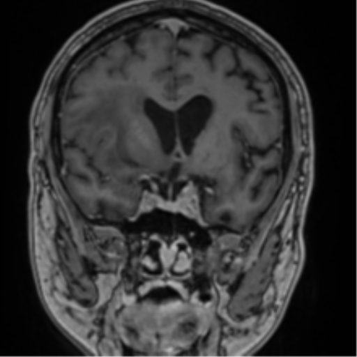 File:Atypical meningioma (WHO grade II) with brain invasion (Radiopaedia 57767-64729 Coronal T1 C+ 35).png