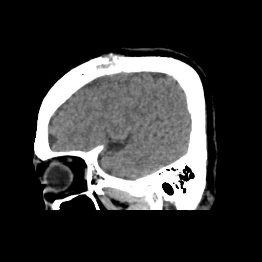 Atypical meningioma with skull invasion (Radiopaedia 34357-35649 E 11).png