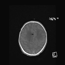 Atypical teratoid rhabdoid tumor (prenatal US and neonatal MRI) (Radiopaedia 59091-66388 Axial T1 45).jpg