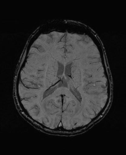 Autoimmune limbic encephalitis (Radiopaedia 30363-31005 SWI 46).jpg
