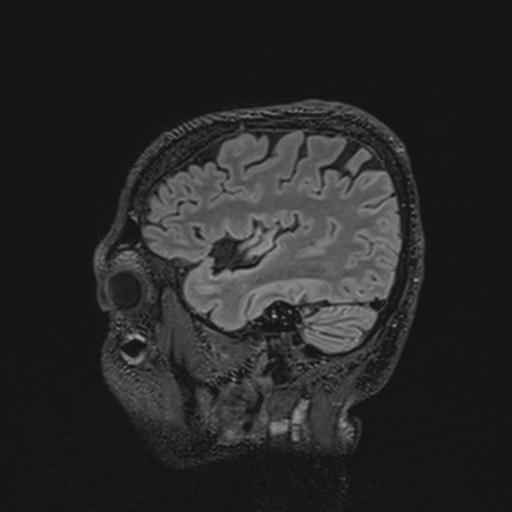 Autoimmune limbic encephalitis (Radiopaedia 30363-31005 Sagittal FLAIR 41).jpg