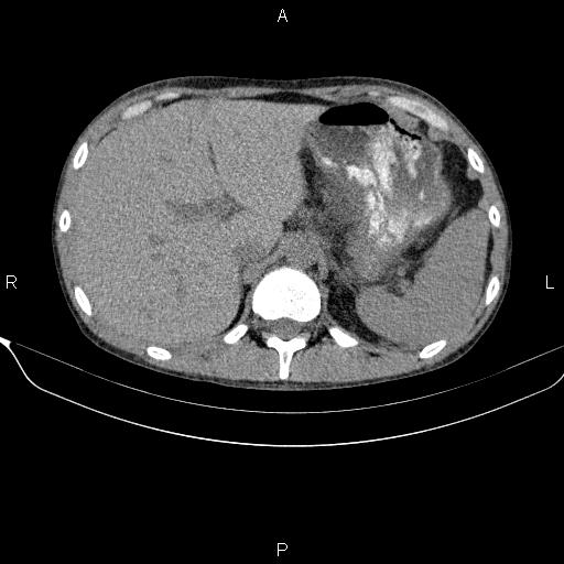 Autoimmune pancreatitis (Radiopaedia 84925-100431 Axial non-contrast 16).jpg