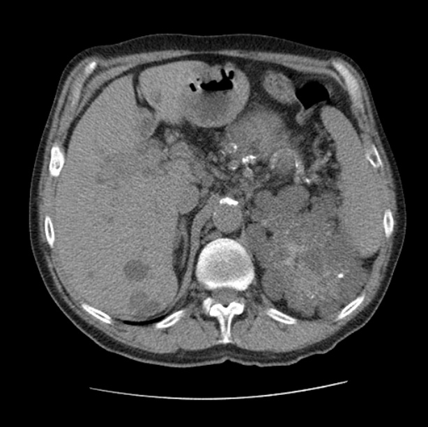 Autosomal dominant polycystic kidney disease (Radiopaedia 27851-28094 Axial non-contrast 57).jpg