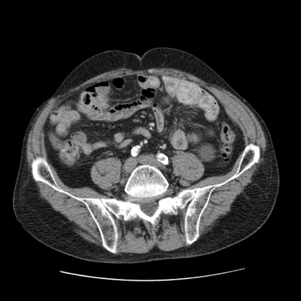 Autosomal dominant polycystic kidney disease (Radiopaedia 27851-28094 B 91).jpg