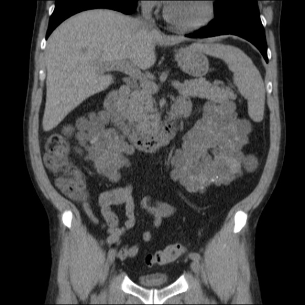 Autosomal dominant polycystic kidney disease (Radiopaedia 36539-38101 C 31).jpg