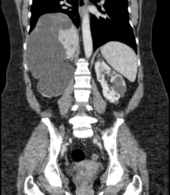 Autosomal dominant polycystic kidney disease (Radiopaedia 57124-64017 B 51).jpg