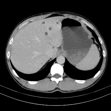 Autosomal dominant polycystic kidney disease (Radiopaedia 66349-75582 B 15).jpg