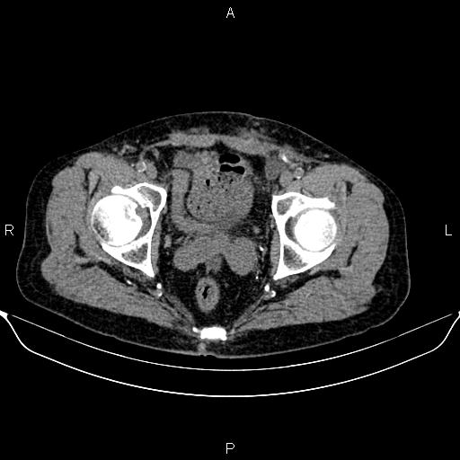Autosomal dominant polycystic kidney disease (Radiopaedia 87830-104287 Axial non-contrast 52).jpg
