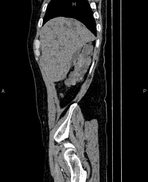 Autosomal dominant polycystic kidney disease (Radiopaedia 87830-104287 C 9).jpg