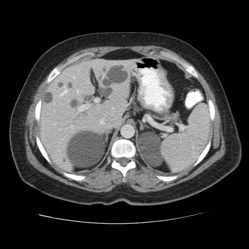 File:Autosomal dominant polycystic kidney disease with hepatic involvement (Radiopaedia 32693-33662 B 17).jpg