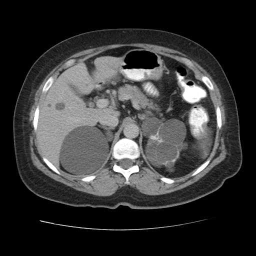 File:Autosomal dominant polycystic kidney disease with hepatic involvement (Radiopaedia 32693-33662 C 22).jpg