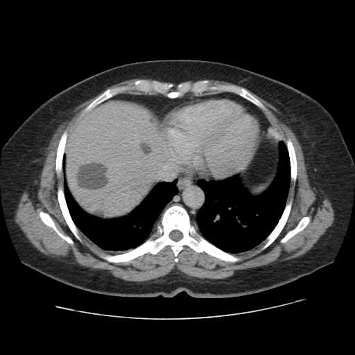 File:Autosomal dominant polycystic kidney disease with hepatic involvement (Radiopaedia 32693-33662 C 6).jpg