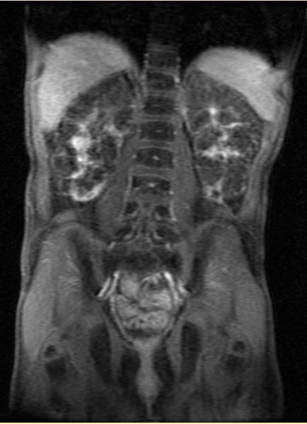 File:Autosomal recessive polycystic kidney disease (Radiopaedia 11224-11589 Coronal T1 fat sat 1).jpg