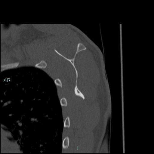 Avascular necrosis after fracture dislocations of the proximal humerus (Radiopaedia 88078-104653 Sagittal bone window 57).jpg