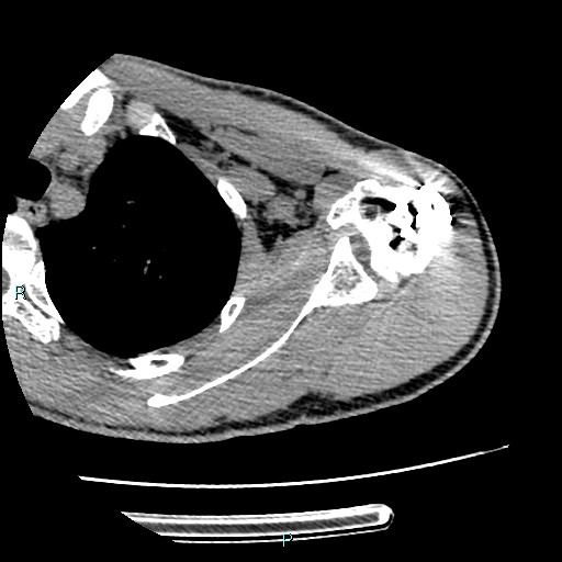 Avascular necrosis after fracture dislocations of the proximal humerus (Radiopaedia 88078-104655 D 53).jpg