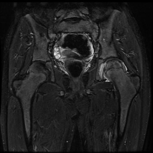 File:Avascular necrosis of the hip (Radiopaedia 29563-30067 Coronal T2 fat sat 9).jpg