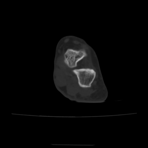 Avulsion fracture of the dorsal cuboid bone (Radiopaedia 51586-57377 Axial bone window 47).jpg