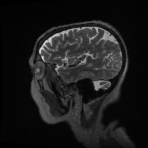 Balo concentric sclerosis (Radiopaedia 53875-59982 Sagittal 3D FSE 54).jpg