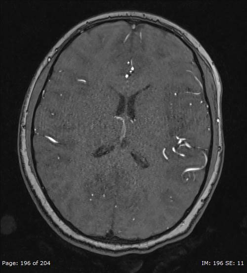 Balo concentric sclerosis (Radiopaedia 61637-69636 Axial MRA 196).jpg