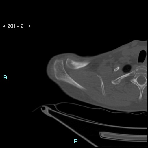 File:Bankart lesion with glenoid bone defect - assessment TC with PICO method (Radiopaedia 42855-93901 Axial bone window 20).jpg