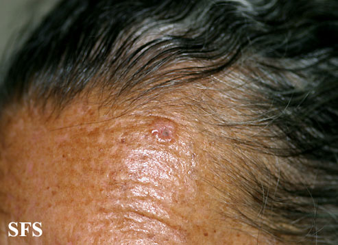 Basal Cell Carcinoma (Dermatology Atlas 129).jpg