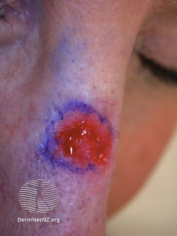 File:Basal cell carcinoma affecting the nose (DermNet NZ lesions-bcc-nose-1024).jpg