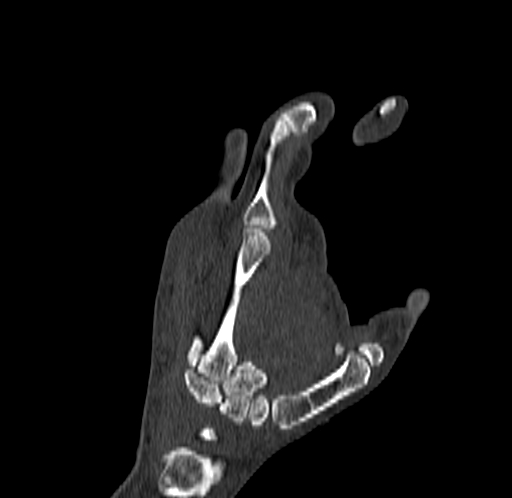 Base of 2nd metacarpal fracture (Radiopaedia 73741-84544 Coronal bone window 56).jpg