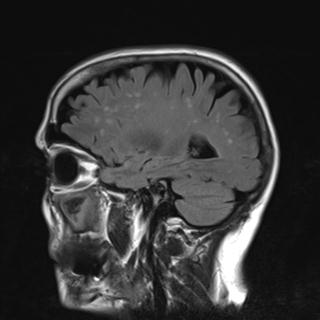 File:Base of skull chondrosarcoma (Radiopaedia 30410-31070 Sagittal FLAIR 5).jpg