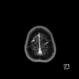Base of skull rhabdomyosarcoma (Radiopaedia 32196-33142 T1 C+ fat sat 69).jpg
