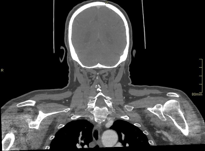 Basilar artery aneurysm (Radiopaedia 56261-62932 B 54).jpg