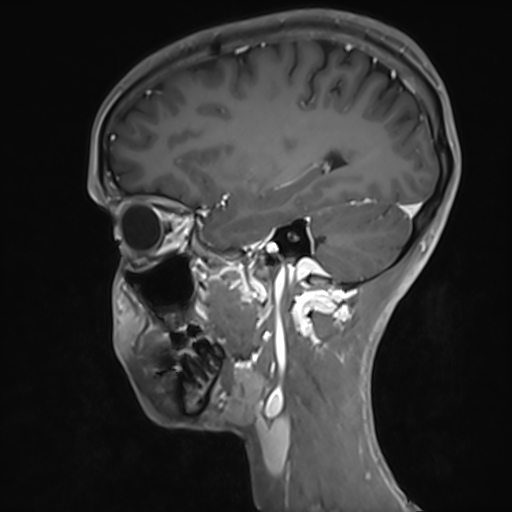 Basilar artery perforator aneurysm (Radiopaedia 82455-97733 G 48).jpg