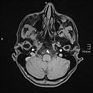 Basilar artery perforator aneurysm (Radiopaedia 82455-99523 F 15).jpg