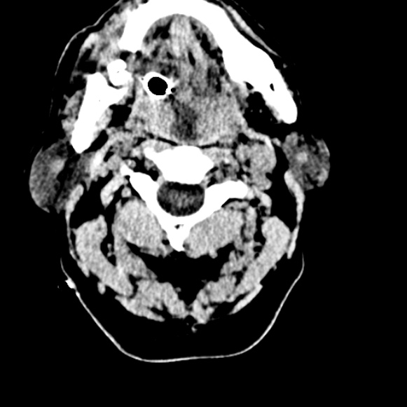 Basilar artery thrombosis (Radiopaedia 53351-59333 Axial non-contrast 1).jpg