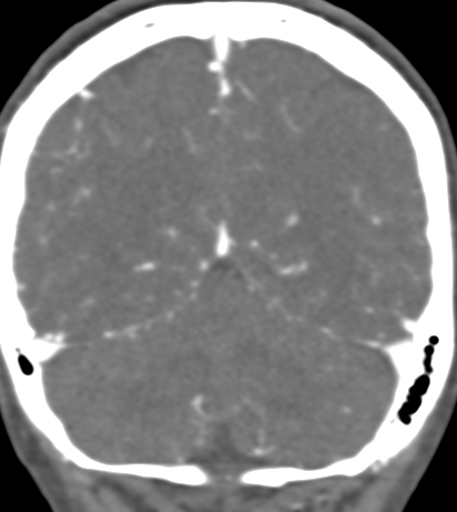 Basilar tip aneurysm with coiling (Radiopaedia 53912-60086 B 120).jpg