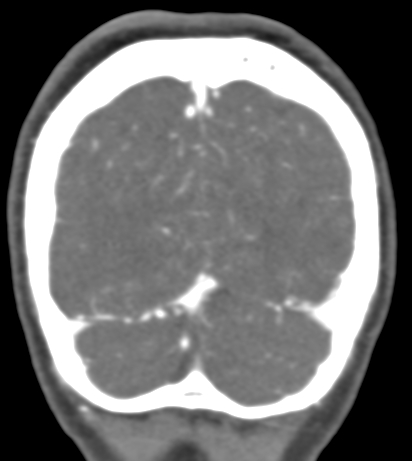 Basilar tip aneurysm with coiling (Radiopaedia 53912-60086 B 138).jpg