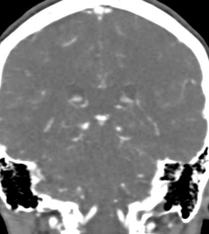 File:Basilar tip aneurysm with coiling (Radiopaedia 53912-60086 B 99).jpg