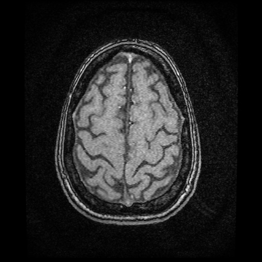 Basilar top and left middle cerebral artery aneurysm (Radiopaedia 61965-70031 Axial MRA 146).jpg