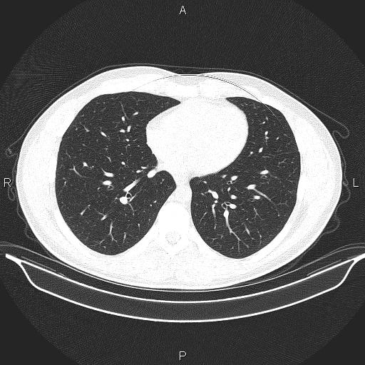 Beam hardening and ring artifacts (Radiopaedia 85323-100915 Axial lung window 50).jpg